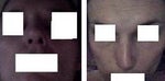 Nose Asymetry 6 Weeks Postop - California, CA