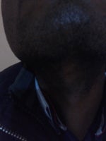 what can i do to reduce the darkness of my chin and neck which resulted from irritation by the shaving cream i used for once?