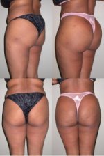 10 Things I Wish I Knew Before Butt Augmentation