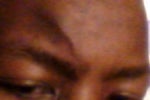 Injury Related Facial Scarring, Raised on One Side of the Cut