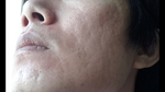 What treatment is best for my acne scarring on my cheek ?