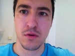 correction of hollow eyes?