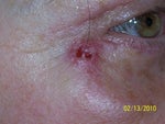 Can this bad blepharoplasty be fixed?