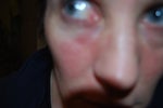 Itching after Restylane under eyes