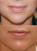 Silikon 1000 for Lip Augmentation