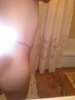 5 months post op / FTT. As the day goes on, the area right above my belly button bulges out, is this normal?