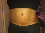 1 month post op update w/ picture