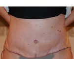 Please look at my picture...what is this? 11 days post op full tt