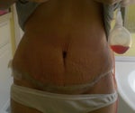 Hip Swelling?