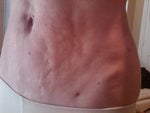 uneven skin after smart lipo- need advice..