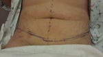 7 days post op