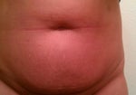 Wondering if my tummy is "bad" enough for a full tuck....?