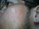 Hi! My Name is Anderson Any Knows Someone in DC/VA/MD That Does Subcision 4 Acne Thank You