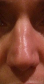 Revision Rhinoplasty - starting to feel it will never be fixed!