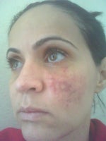 Juvederm Inflamation