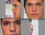 Septo/Rhinoplasty Swelling 7 months later
