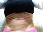 Do You Think I'm a Good Candidate for a Tummy Tuck?