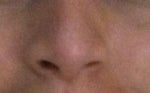 Uneven nostrils after rhinoplasty