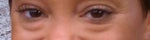 Did You Expect Such a Long Recovery After Transconjunctival Blepharoplasty?