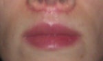 My Bull Horn Lip Lift Asymmetry