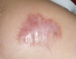 Is this a keloid?