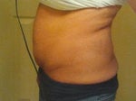 Do you think I need a tummy tuck?