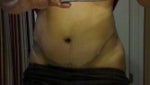 Anyone have a high V or W shaped scar like mine??