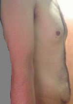 Is tummy tuck a must for me?