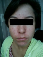 Getting redness, peeling, and breakouts from Differin after 5 weeks.