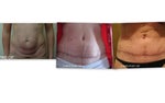 Best silicone sheets to use for tummy tuck scar?