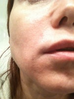 Reversing the effects of Radiesse