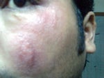 Still having rashes & itchness after Fraxel