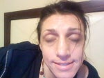 Uneven nostril and speader graft bumps after septorhinoplasty