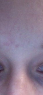 Minor acne scars and microdermabrasion