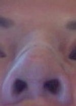 Nose tip too round after rhinoplasty
