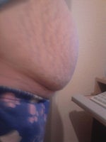 Tummy tuck on the NHS