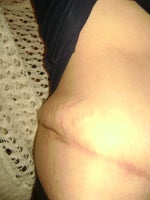 How to fix dog ears after bad tummy tuck?