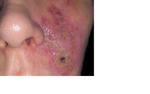 Serious side effects after a Radisse injection
