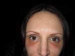 Redness and bruising after Radiesse under eyes