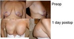 Reassurance about breast lift with implants
