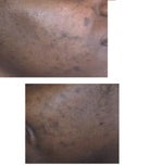 Treatment for acne scars and hyperpigmentation on dark skin
