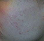 Stubborn broken capillaries on face