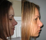 Does nose tip drop after rhinoplasty?