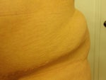 Hip bulges/loose skin after tummy tuck?