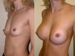 Breast lift with implant or without implant