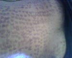Profractional Laser burns over laser hair removal burns?