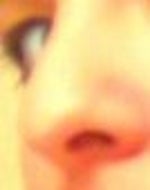Is elevating tip of the nose a minor procedure?