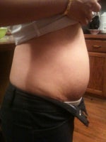 Concerns with second tummy tuck