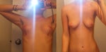 Breast augmentation after previous breast lift a good idea?