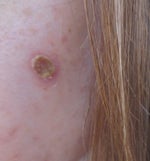 Is greenish scab normal after a photofacial?